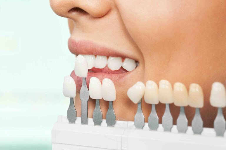 Fa male limare i denti per applicare le faccette