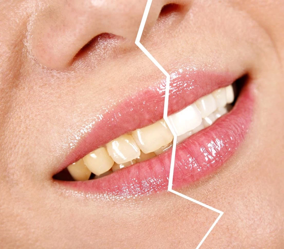 Lo sbiancamento dentale è realtà 2 Sbiancamento dentale