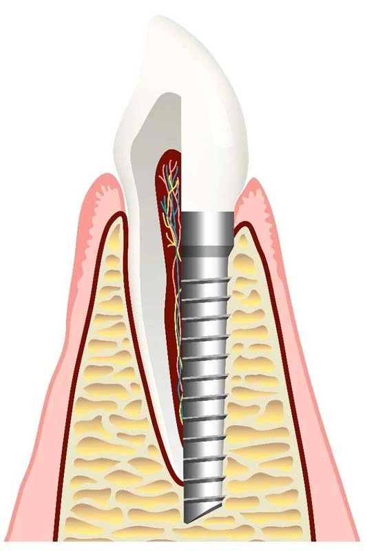 implantologia computer guidata