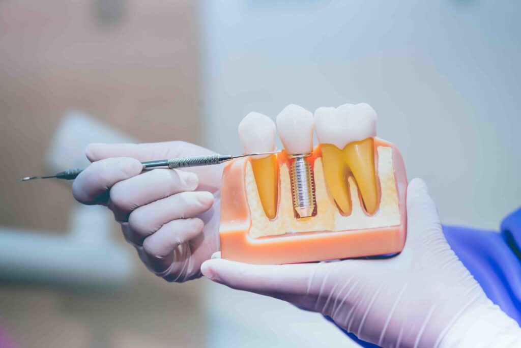Quanto durano gli impianti dentali 1 Quanto durano gli impianti dentali