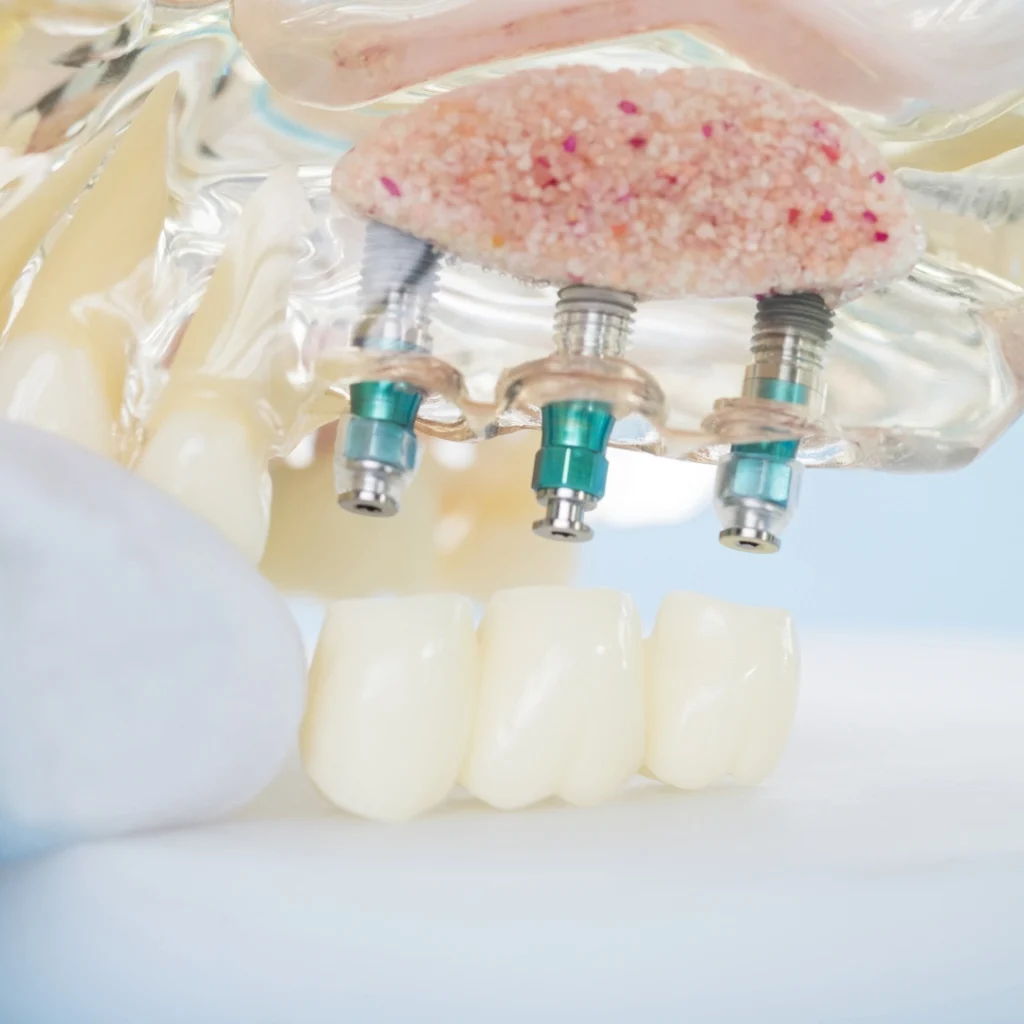 rialzo seno mascellare