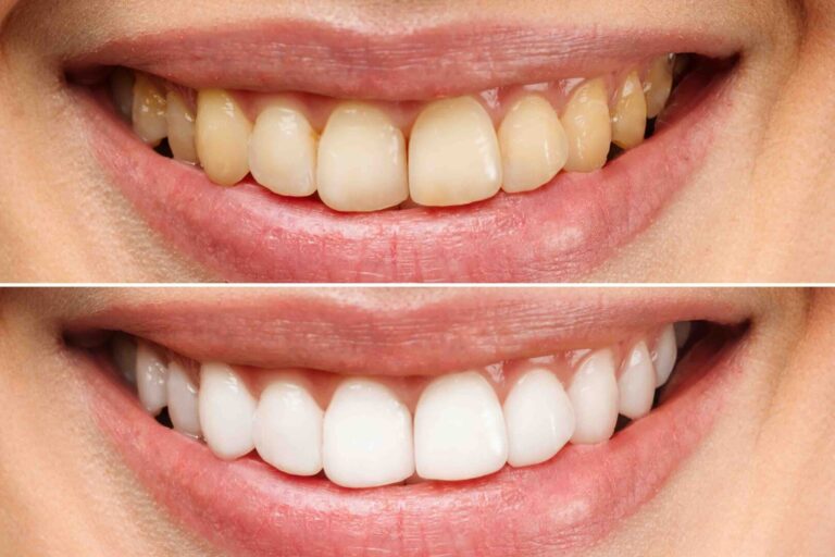 Sbiancamento di denti con apparecchio